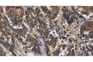 Immunohistochemistry of paraffin-embedded Human liver cancer using FRK Polyclonal Antibody at dilution of 1:50 (FRK 抗体)
