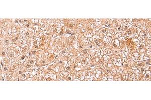 Immunohistochemistry of paraffin-embedded Human liver cancer tissue using ASTN2 Polyclonal Antibody at dilution of 1:80(x200) (Astrotactin 2 抗体)