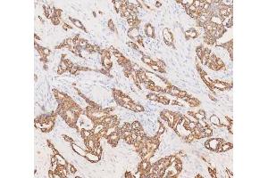 IHC analysis of Cytokeratin 19 using anti-Cytokeratin 19 antibody (ABIN3043288). (Cytokeratin 19 抗体  (C-Term))