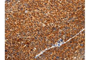 The image on the left is immunohistochemistry of paraffin-embedded Human liver cancer tissue using ABIN7131154(SPATA13 Antibody) at dilution 1/20, on the right is treated with fusion protein.