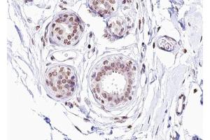 Immunohistochemistry (IHC) image for anti-Estrogen Receptor 1 (ESR1) (pSer104) antibody (ABIN6256090)