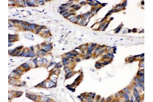 Anti- DLD Picoband antibody, IHC(P) IHC(P): Human Intestinal Cancer Tissue (DLD 抗体  (AA 300-509))