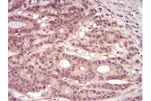 Immunohistochemical analysis of paraffin-embedded colon cancer tissues using PKN1 mouse mAb with DAB staining. (PKN1 抗体  (AA 442-620))