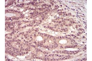 Immunohistochemical analysis of paraffin-embedded colon cancer tissues using PKN1 mouse mAb with DAB staining.