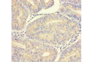 Immunohistochemistry of paraffin-embedded human endometrial cancer using ABIN7165325 at dilution of 1:100 (LMAN1L 抗体  (AA 26-462))