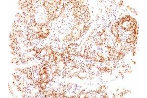 Formalin-fixed, paraffin-embedded human ovarian carcinoma stained with Estrogen Receptor beta antibody (ESR2/686). (ESR2 抗体  (C-Term))