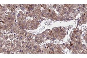 ABIN6273970 at 1/100 staining Human liver cancer tissue by IHC-P. (OR1J4 抗体  (C-Term))