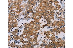 Immunohistochemistry of Human thyroid cancer using TAB3 Polyclonal Antibody at dilution of 1:35 (TAB3 抗体)