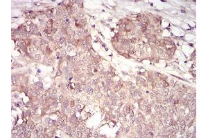 Immunohistochemical analysis of paraffin-embedded bladder cancer tissues using CCNA2 mouse mAb with DAB staining. (Cyclin A 抗体  (AA 105-233))