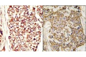 (LEFT)Formalin-fixed and paraffin-embedded human cancer tissue reacted with the primary antibody, which was peroxidase-conjugated to the secondary antibody, followed by AEC staining. (ErbB2/Her2 抗体  (N-Term))