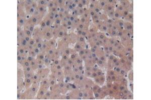 IHC-P analysis of Human Liver Cancer Tissue, with DAB staining. (ALT 抗体  (AA 255-496))