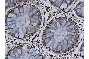 Formalin-fixed and paraffin embedded tumor tissue labeled with Anti-APOJ/Clusterin-? (Clusterin 抗体  (AA 331-449))