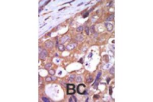 Formalin-fixed and paraffin-embedded human cancer tissue reacted with PRKD1 polyclonal antibody  , which was peroxidase-conjugated to the secondary antibody, followed by AEC staining . (PKC mu 抗体  (N-Term))