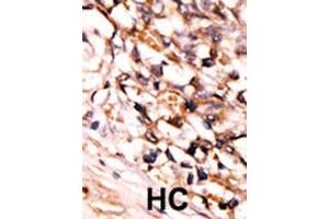 Formalin-fixed and paraffin-embedded human cancer tissue reacted with the primary antibody, which was peroxidase-conjugated to the secondary antibody, followed by DAB staining. (MAPKAP Kinase 5 抗体  (pSer93))
