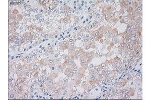 Immunohistochemical staining of paraffin-embedded Carcinoma of kidney tissue using anti-KRT19mouse monoclonal antibody. (Cytokeratin 19 抗体  (AA 240-390))