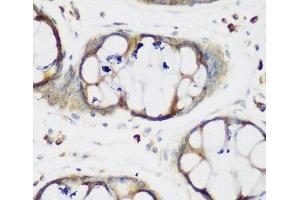 Immunohistochemistry of paraffin-embedded Human gastric using MTDH Polyclonal Antibody at dilution of 1:200 (40x lens). (MTDH 抗体)