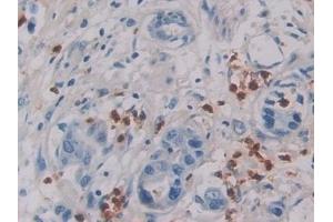Detection of IL6 in Human Breast cancer Tissue using Monoclonal Antibody to Interleukin 6 (IL6) (IL-6 抗体  (AA 27-212))