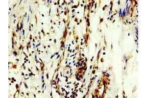 IHC image of ABIN7160441 diluted at 1:300 and staining in paraffin-embedded human bladder cancer performed on a Leica BondTM system. (MYT1 抗体  (AA 317-451))