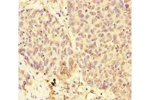 Immunohistochemistry of paraffin-embedded human ovarian cancer using ABIN7174302 at dilution of 1:100 (USP28 抗体  (AA 430-580))