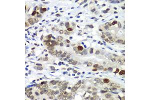 Immunohistochemistry of paraffin-embedded human gastric cancer using DR1 antibody at dilution of 1:100 (x40 lens). (DR1 抗体)