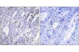 Immunohistochemistry analysis of paraffin-embedded human colon carcinoma tissue, using MEF2D (Ab-444) Antibody. (MEF2D 抗体  (AA 410-459))