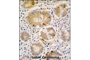Formalin-fixed and paraffin-embedded human colon carcinoma tissue reacted with Autophagy G16L antibody (C-term), which was peroxidase-conjugated to the secondary antibody, followed by DAB staining. (ATG16L1 抗体  (C-Term))