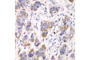 Immunohistochemistry of paraffin-embedded human esophageal cancer using ALDH2 antibody. (ALDH2 抗体)