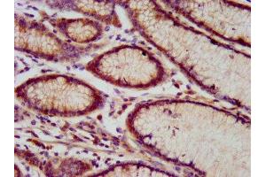 IHC image of ABIN7151176 diluted at 1:800 and staining in paraffin-embedded human gastric cancer performed on a Leica BondTM system. (RNF213 抗体  (AA 202-350))