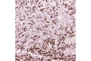 IHC testing of FFPE human gastric cancer with Cathepsin E antibody at 2ug/ml. (Cathepsin E 抗体  (AA 150-393))