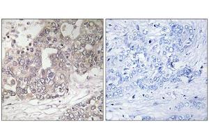 Immunohistochemistry analysis of paraffin-embedded human liver carcinoma tissue using ATG4C antibody.