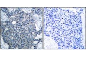 Immunohistochemistry analysis of paraffin-embedded human breast carcinoma tissue, using Stathmin 1 (Ab-24) Antibody. (Stathmin 1 抗体  (AA 9-58))