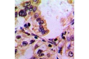 Immunohistochemical analysis of PABPC5 staining in human lung cancer formalin fixed paraffin embedded tissue section. (PABPC5 抗体)