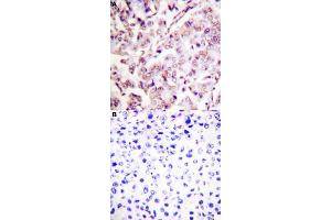 Immunohistochemical staining (Formalin-fixed paraffin-embedded sections) of human breast cancer tissue with ETS1 (phospho T38) polyclonal antibody  without blocking peptide (A) or preincubated with blocking peptide (B) under 1:50-1:100 dilution. (ETS1 抗体  (pThr38))