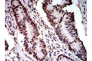 Immunohistochemical analysis of paraffin-embedded colon cancer tissues using DDX1 mouse mAb with DAB staining. (DDX1 抗体  (AA 642-740))