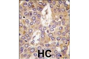 Formalin-fixed and paraffin-embedded human hepatocarcinoma tissue reacted with CK1g2 antibody (C-term), which was peroxidase-conjugated to the secondary antibody, followed by DAB staining. (Casein Kinase 1 gamma 2 抗体  (C-Term))