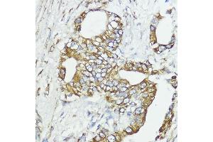 Immunohistochemistry of paraffin-embedded human lung cancer using SOCS6 antibody (ABIN6128785, ABIN6148273, ABIN6148274 and ABIN6225294) at dilution of 1:100 (40x lens). (SOCS6 抗体  (AA 1-210))