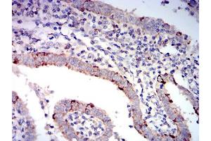 Immunohistochemical analysis of paraffin-embedded endometrial cancer tissues using BAX mouse mAb with DAB staining. (BAX 抗体  (AA 13-160))