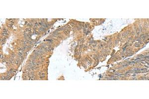Immunohistochemistry of paraffin-embedded Human colorectal cancer tissue using RAB23 Polyclonal Antibody at dilution of 1:50(x200) (RAB23 抗体)