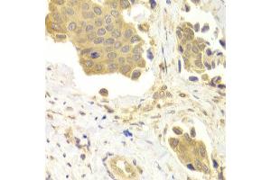 Immunohistochemistry of paraffin-embedded Human mammary cancer using GABARAP antibody at dilution of 1:100 (x400 lens). (GABARAP 抗体)