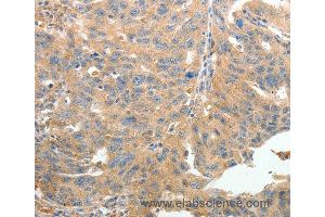 Immunohistochemistry of Human thyroid cancer using TERT Polyclonal Antibody at dilution of 1:50 (TERT 抗体)