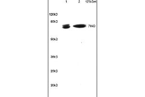 Formalin-fixed and paraffin embedded human gastric carcinoma labeled with Rabbit Anti BCL-6/5 Polyclonal Antibody, Unconjugated (ABIN749843) at 1:200 followed by conjugation to the secondary antibody and DAB staining (BCL6 抗体  (AA 501-600))