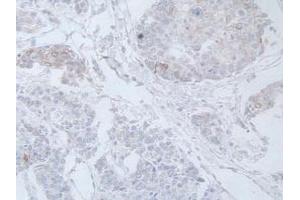 DAB staining on IHC-P; Samples: Human Prostate Gland Cancer Tissue. (IL-19 抗体  (AA 25-177))