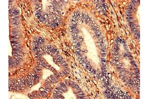 Immunohistochemistry analysis of human colon cancer using ABIN7176531 at dilution of 1:100