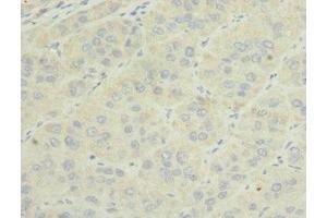 Immunohistochemistry of paraffin-embedded human liver cancer using ABIN7159816 at dilution of 1:100 (OGN 抗体  (AA 20-298))