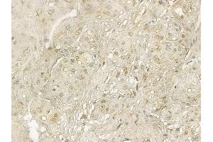 PCGF1 Mouse Monoclonal Antibody at 1/100 staining human esophageal cancer and adjacent non-tumor tissue by IHC-P. (PCGF1 抗体)