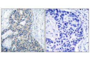 Immunohistochemical analysis of paraffin-embedded human breast carcinoma tissue using Stathmin 1(Phospho-Ser38) Antibody(left) or the same antibody preincubated with blocking peptide(right). (Stathmin 1 抗体  (pSer38))