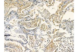 DKK1 Mouse Monoclonal Antibody at 1/100 staining human pancreatic cancer by IHC-P. (DKK1 抗体  (Internal Region))
