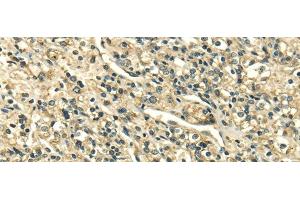 Immunohistochemistry of paraffin-embedded Human prostate cancer tissue using SDF4 Polyclonal Antibody at dilution 1:35 (SDF4 抗体)