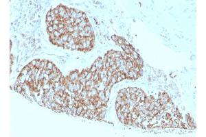 Formalin-fixed, paraffin-embedded human breast carcinoma stained with Calprotectin Mouse Monoclonal Antibody (S100A9/1075). (S100A9 抗体)