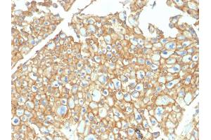 Formalin-fixed, paraffin-embedded human Renal Cell Carcinoma stained with EpCAM Rabbit Polyclonal Antibody. (EpCAM 抗体)